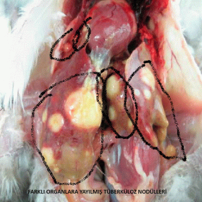 TÜBERKÜLOSİS